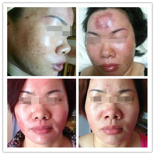 化妆品汞中毒症状图片图片
